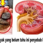Penyebab Batu Ginjal dan Solusi Herbal untuk anda