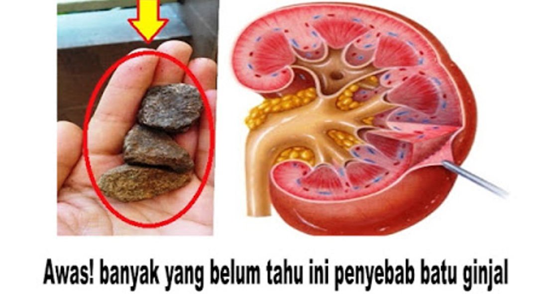 Penyebab Batu Ginjal dan Solusi Herbal untuk anda