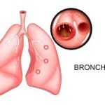 Bronchitis, radang tenggorokan, pancingen atau yg lain?
