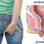 Terlalu banyak makan pedas, waspadai gejala ambeien