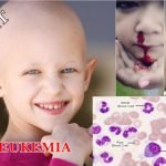 Pengertian, Gejala dan Penyebab Leukemia