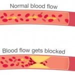 Pantangan, Gejala dan Penyebab Penyakit Kolesterol