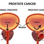 Kesaksian Prostat LANGSUNG SEMBUH