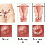 Gejala Kanker Serviks, Obati dengan Herbal