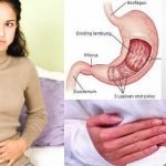 Penyebab Asam Lambung Naik dan Gejala “GERD”