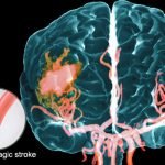 Pencegahan stroke hanya dengan 3 cara