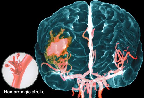 Pencegahan stroke hanya dengan 3 cara