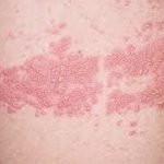 Cara mudah sembuh dari herpes zoster