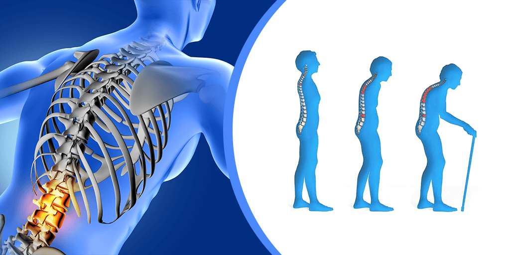 Gejala Osteoporosis dan Penyebab Osteoporosis