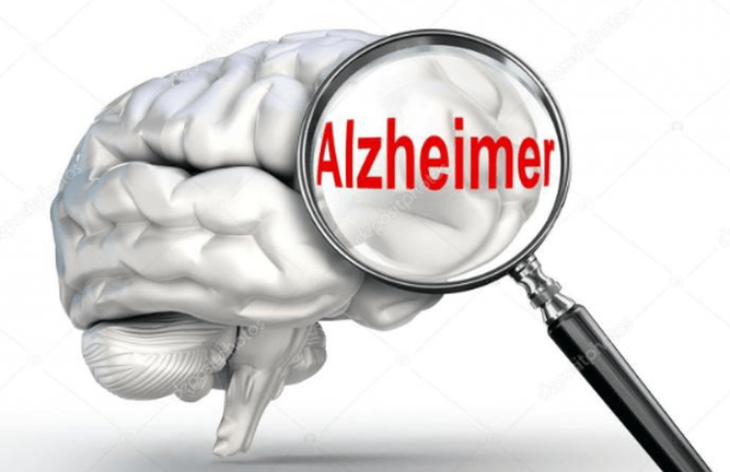 Pengertian, Pencegahan dan Penyebab Alzheimer