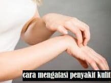 Cara menghilangkan penyakit kusta