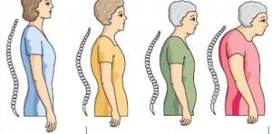 gejala osteoporosis