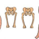 Cara Pencegahan Sederhana Penyakit Rakhitis