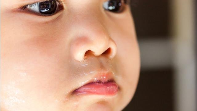 10 Gejala klinis Sinusitis beserta pengertiannya