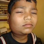 Gondongan ternyata dapat menular. Waspada!