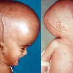 Apa penyebab hidrosepalus ? apa bisa sembuh?