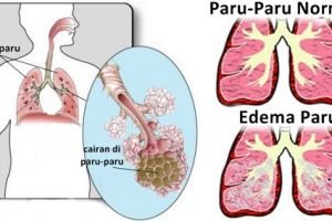 4 herbal yang mampu mengobati edema paru