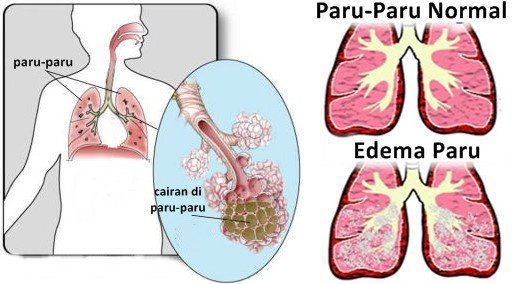 4 herbal yang mampu mengobati edema paru
