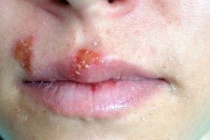 Herpes ternyata menular. Cegah dengan herbal kami
