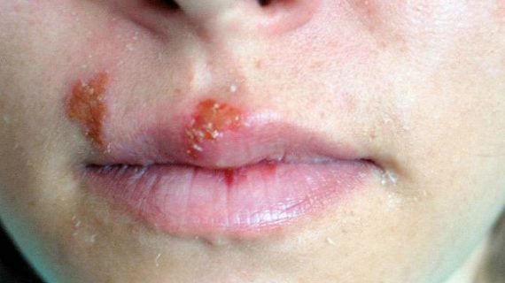 Herpes ternyata menular. Cegah dengan herbal kami