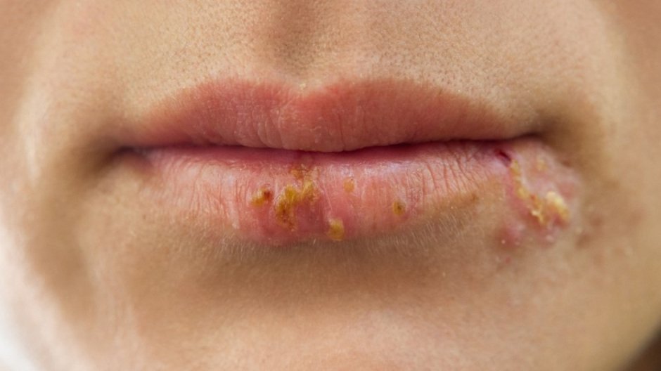 Agarillus Herpes