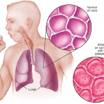 5 cara pencegahan pneumonia (radang paru)