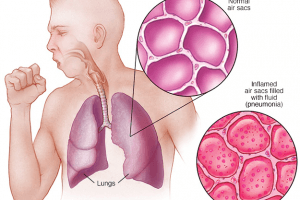 5 cara pencegahan pneumonia (radang paru)