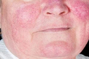 5 faktor lingkungan penyebab penyakit lupus