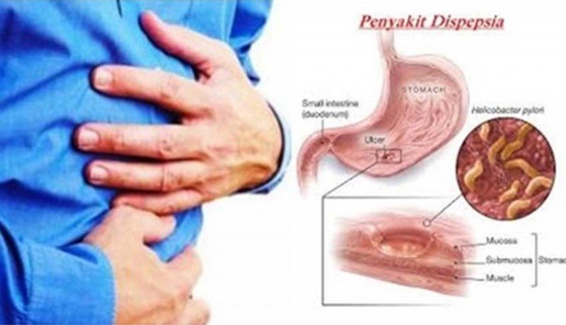 dispepsia