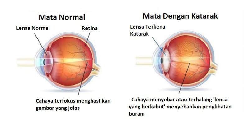 katarak penyebab kebutaan