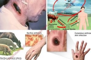 Antraks : Pengertian dan Gejala