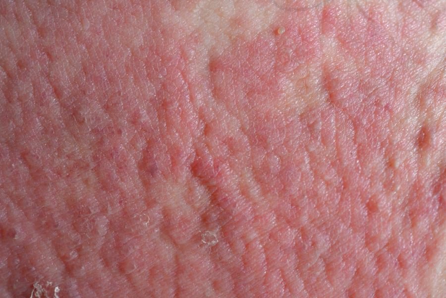 dermatitis atau radang kulit