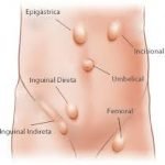 Pengertian dan gejala hernia ? simak artikel berikut