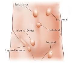Pengertian dan gejala hernia ? simak artikel berikut