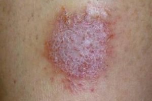 Pengertian, Penyebab dan Gejala Dermatitis