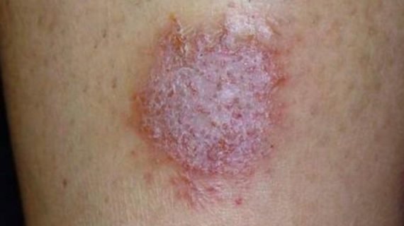 Pengertian, Penyebab dan Gejala Dermatitis