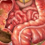 Pelebaran Usus Besar atau MEGAKOLON