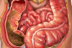 Pelebaran Usus Besar atau MEGAKOLON