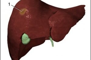 Abses Hati Piogenik ? Cara mengobati dengan Herbal