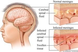 Gejala Tuberkulosis , bukan mual dan muntah ?