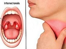 Radang Amandel kronis dapat sembuh. Simak ini