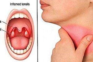 Radang Amandel kronis dapat sembuh. Simak ini