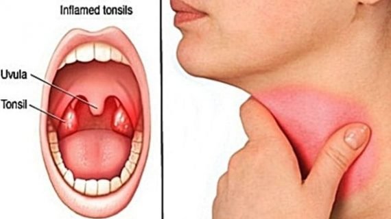 Radang Amandel kronis dapat sembuh. Simak ini