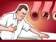 10 Obat Kolesterol Alami bersama Agarillus Herbal