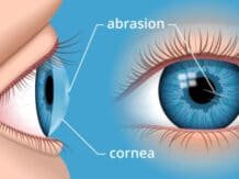 Sakit Abrasi Kornea dan Cara Mengatasinya