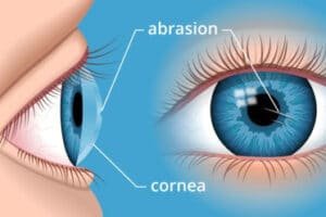 Sakit Abrasi Kornea dan Cara Mengatasinya