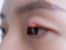 Bahanya Bintitan dan Cara Mengatasinya