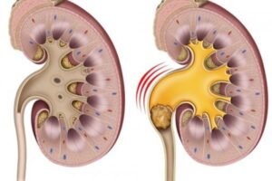 7 Gejala Batu Ginjal, yang ketiga Cukup Menggelisahkan