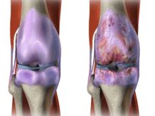 Solusi Sehat Untuk Penderita OsteoArthritis (Pengapuran Sendi)