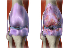 Solusi Sehat Untuk Penderita OsteoArthritis (Pengapuran Sendi)